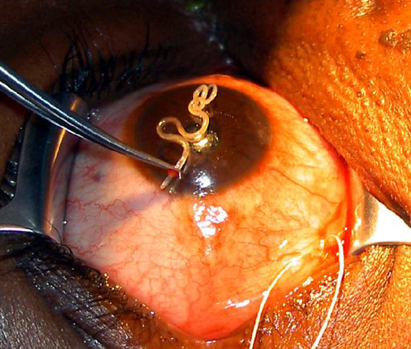 Figure: The actual parasite in the eye.
